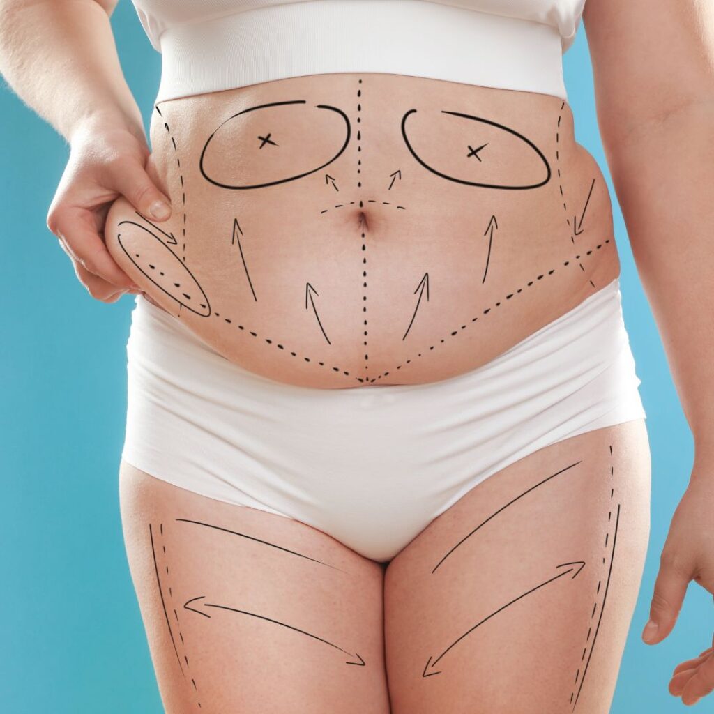 Mummy Makeover in Turkey – All-Inclusive Packages from £5,000