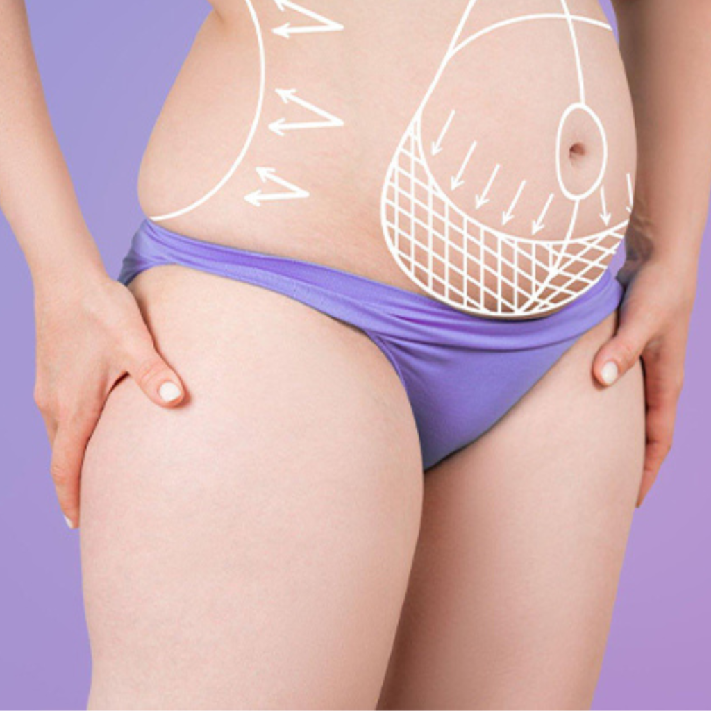 Tummy tuck Turkey treatment at Clinic Phaselis in Antalya