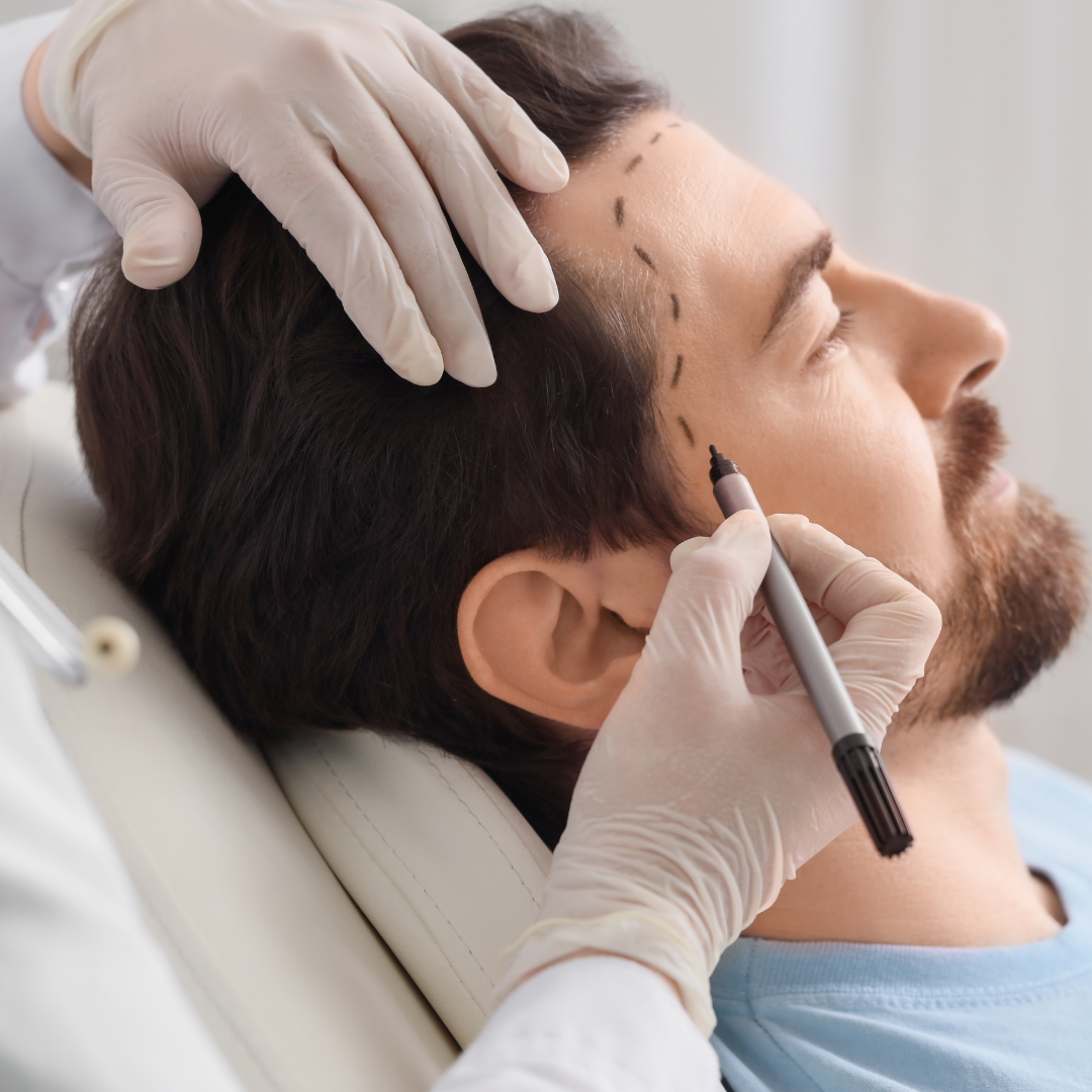 UK patient receiving FUE hair transplant at Clinic Phaselis in Antalya