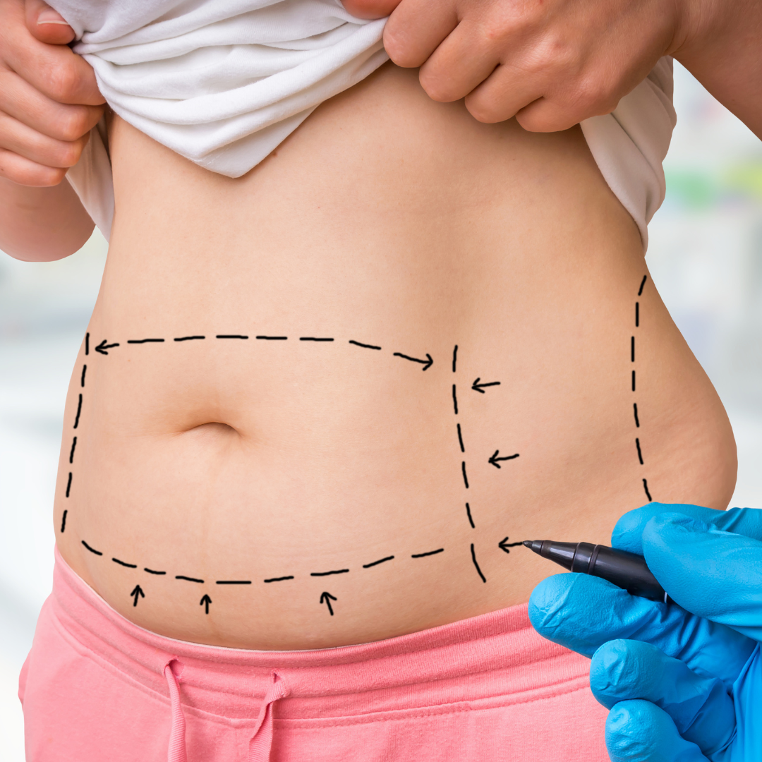 Tummy tuck pre operative markings on abdomen as part of plastic surgery planning in Turkey.