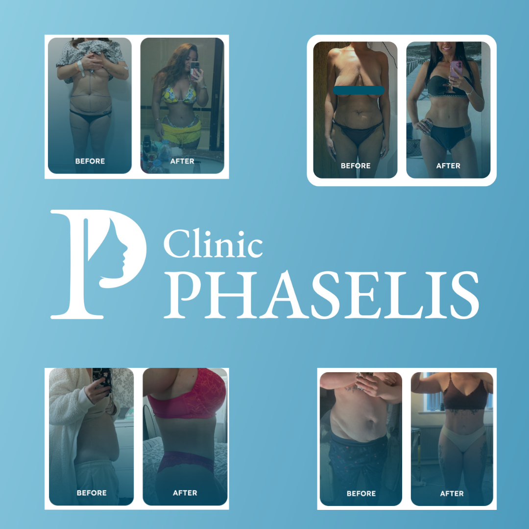 Real mummy makeover before and after results showing tummy tuck and muscle repair after pregnancy