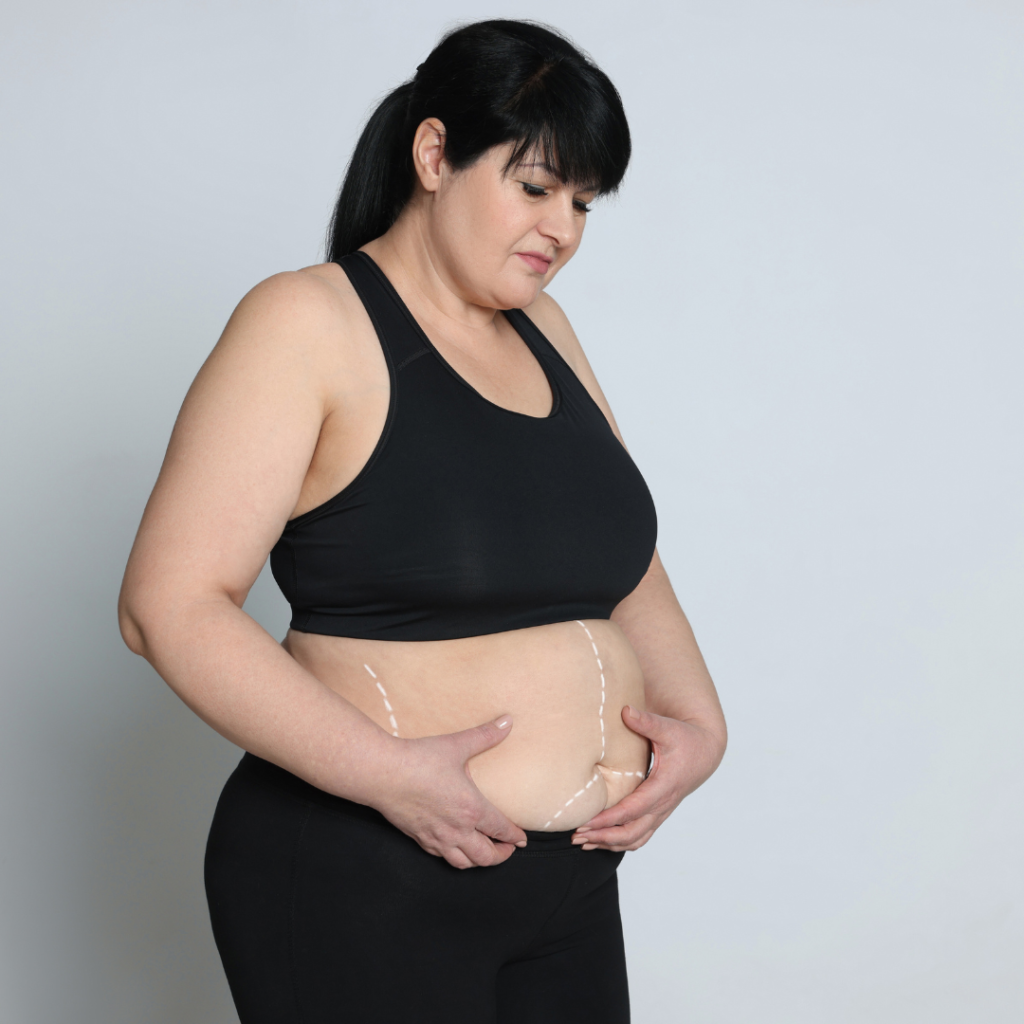 Woman after pregnancy holding loose abdominal skin