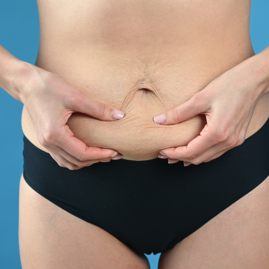 Woman showing abdominal muscle separation and loose skin after pregnancy