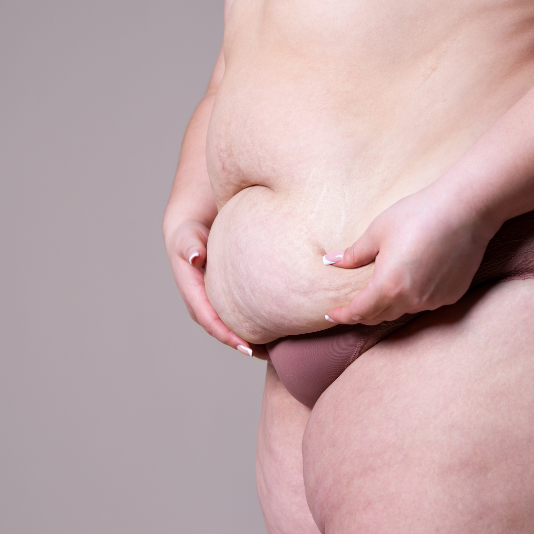 Post pregnancy body changes that a mummy makeover can address, including loose abdominal skin and muscle separation