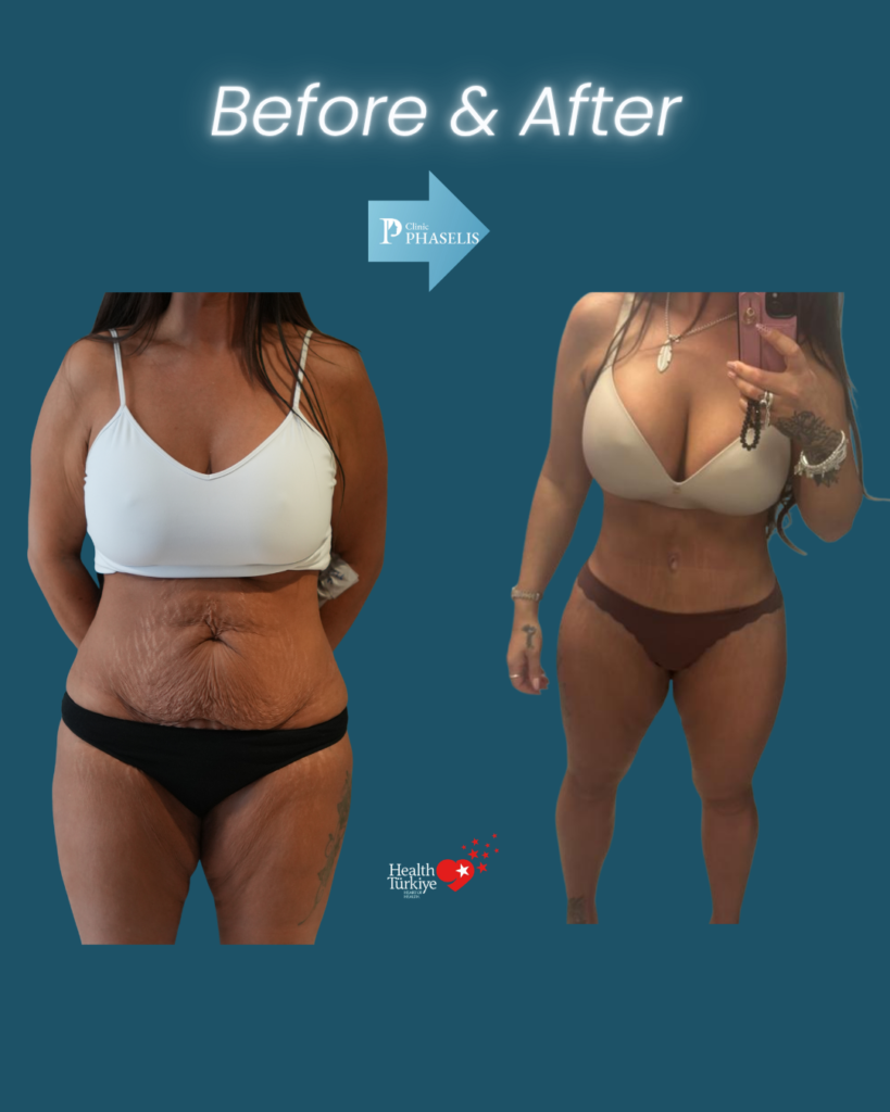 mummy makeover results after pregnancy showing natural abdominal contour and body shape improvement