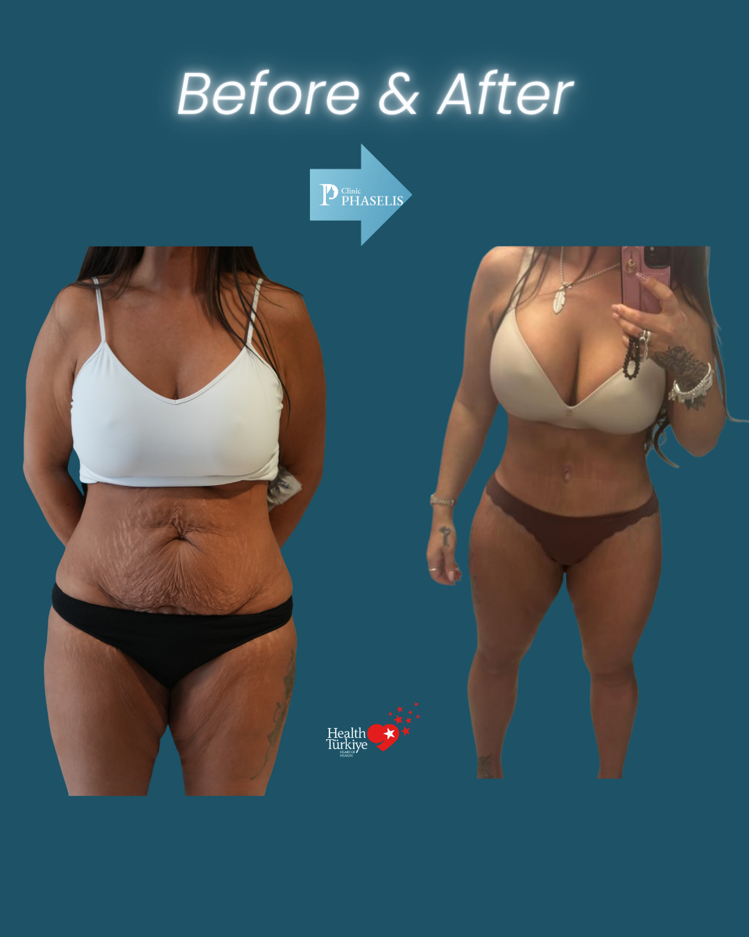 mummy makeover results after pregnancy showing natural abdominal contour and body shape improvement