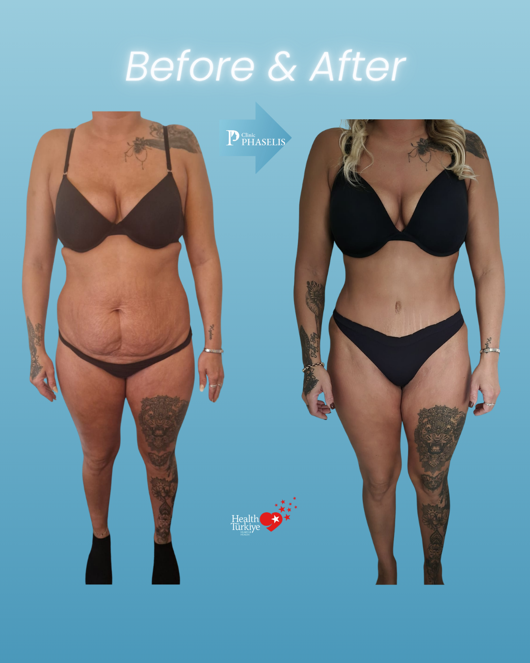 mummy makeover before and after result showing abdomen and body contour improvement after surgery in Turkey