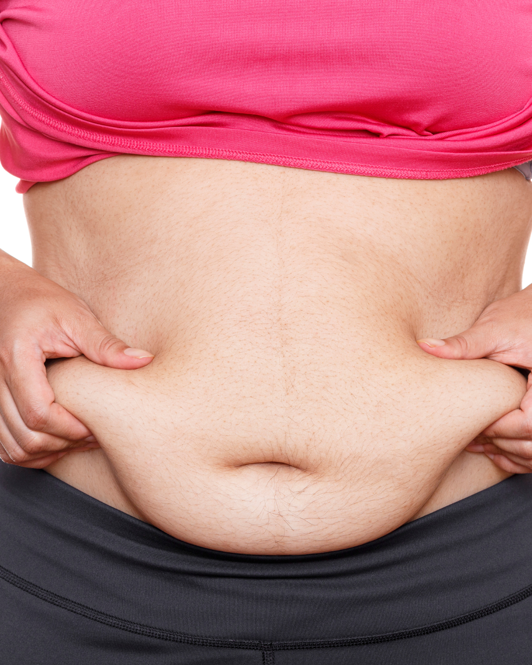 Mummy makeover in Turkey results showing abdominal contour and body shape improvement after pregnancy