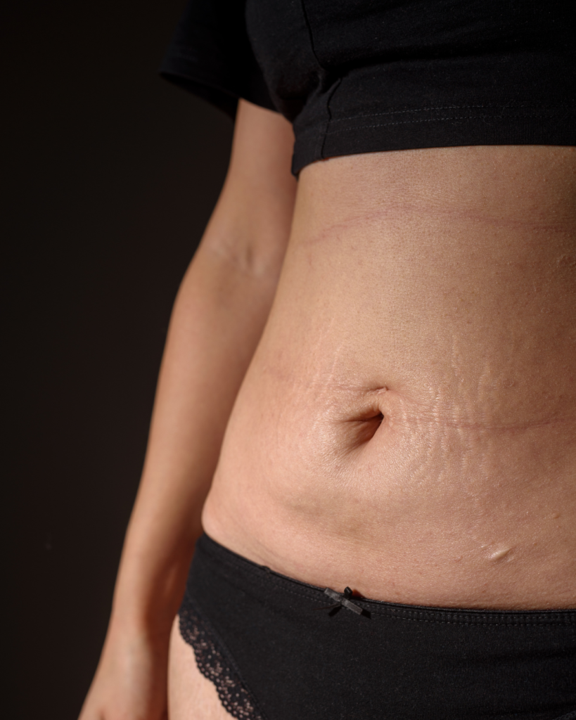 Natural mummy makeover results showing balanced body proportions after tummy tuck and breast surgery