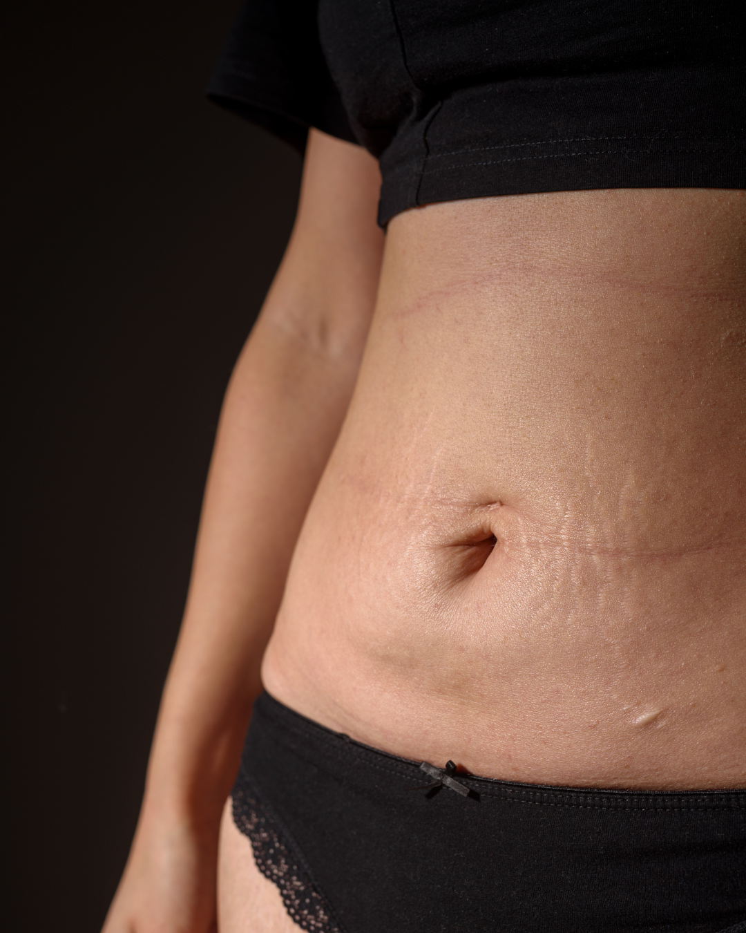 Natural mummy makeover results showing balanced body proportions after tummy tuck and breast surgery