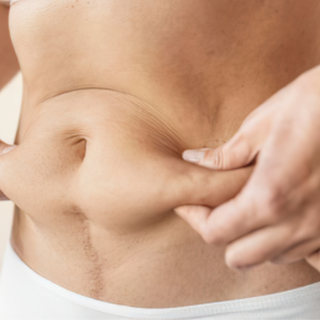 Tummy tuck with Lipo 360 in Turkey