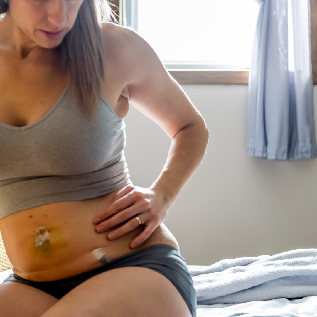 Woman during tummy tuck recovery after abdominal surgery